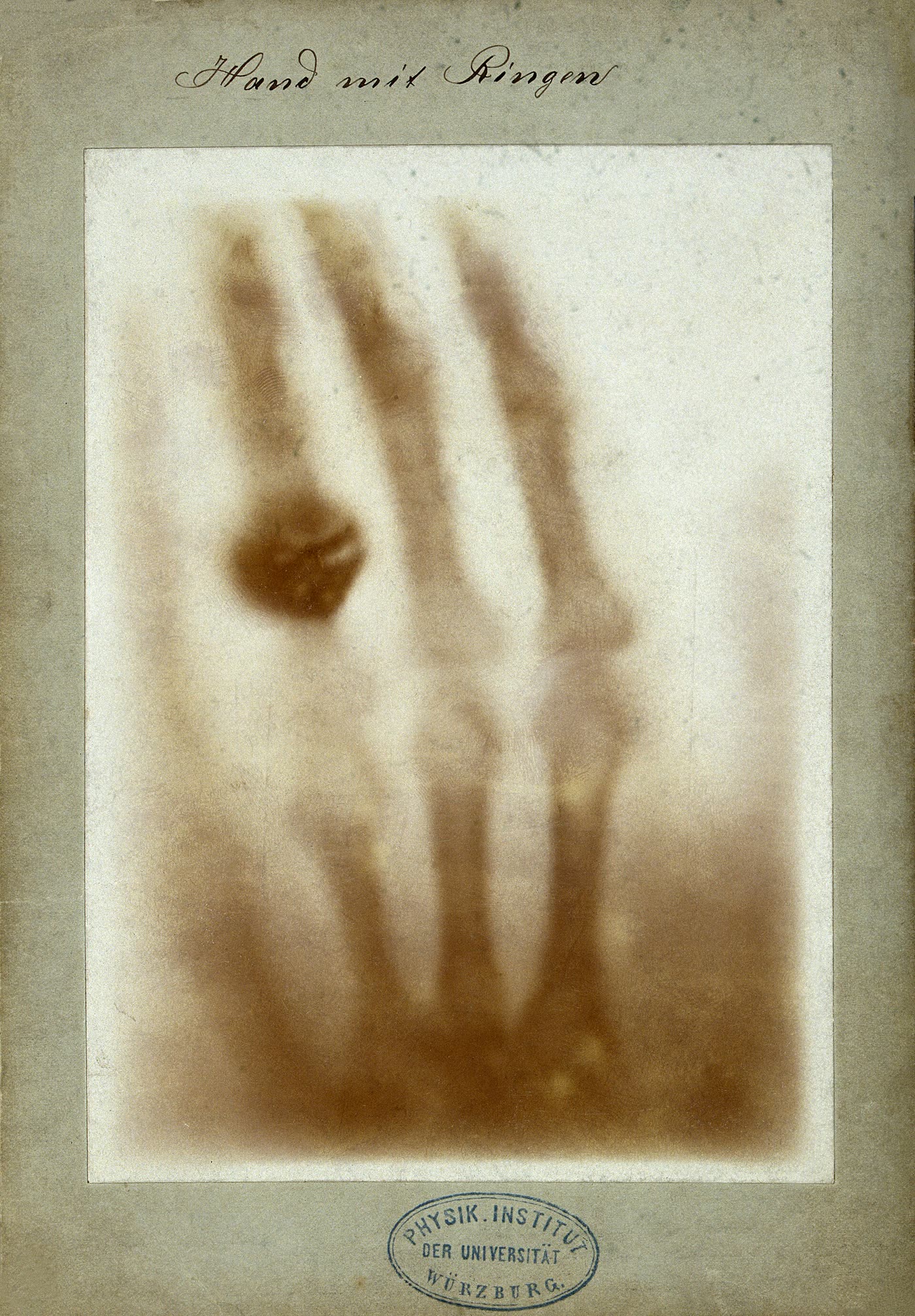 An early X-ray print of a hand wearing a ring, from 1895